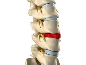 Bulging or Herniated Discs