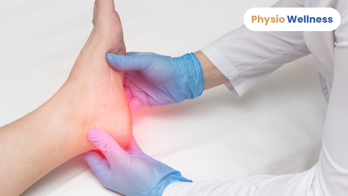 Close-up of a foot and heel affected by plantar fasciitis, Physio Wellness Etobicoke